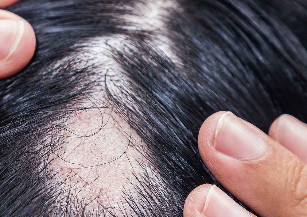 nehoteno-izpadanje las